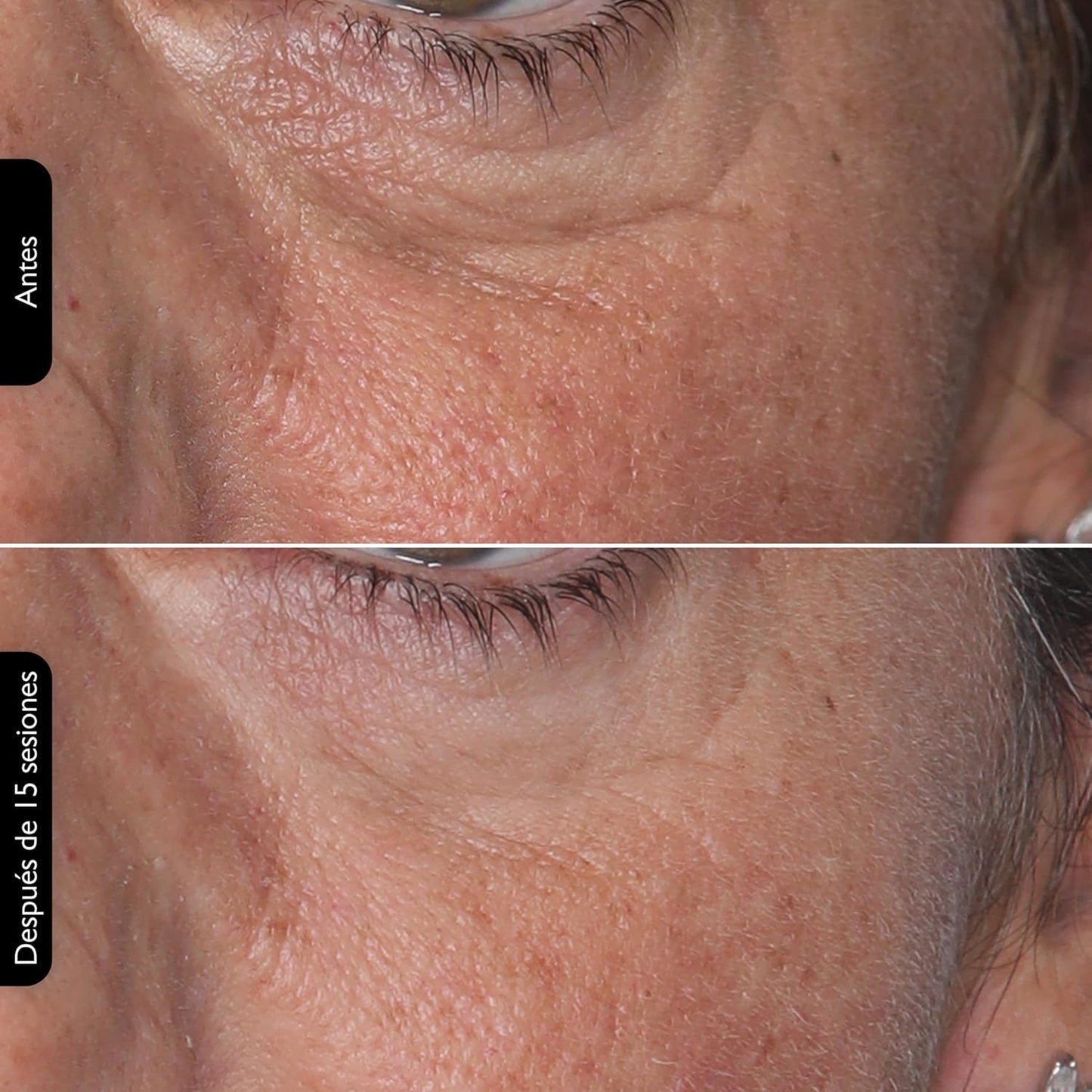 Silk'N Máscara LED Facial I Face LED Mask I Mascarilla Para Rejuvenecer La Piel Y Reducir Manchas I Luz Roja, Azul, Amarilla Y Violeta I Blanca